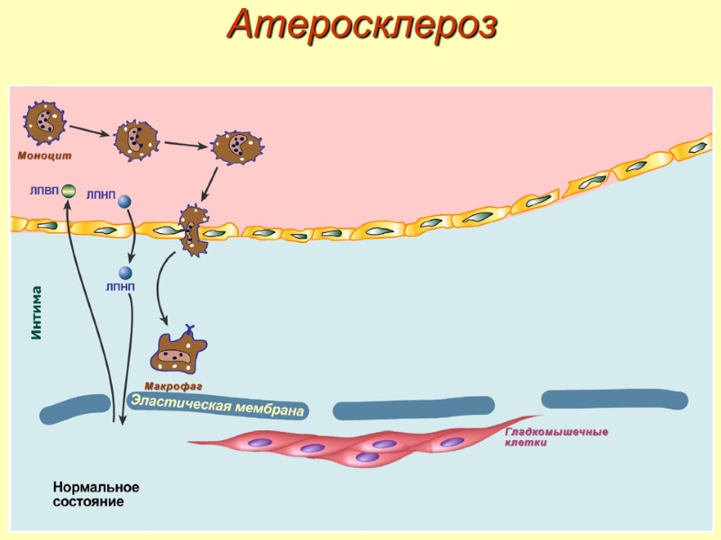 Атеросклероз